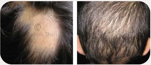 Alopecia before and after homeopathic treatment