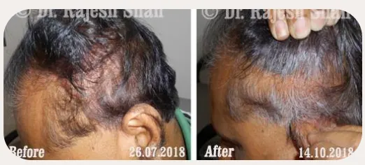 Alopecia Areata before and after homeopathic treatment