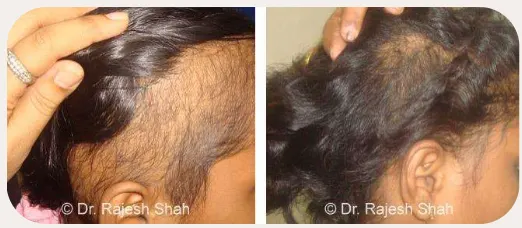 Alopecia before and after homeopathic treatment
