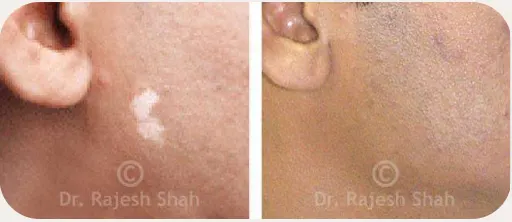 Vitiligo before and after homeopathic treatment