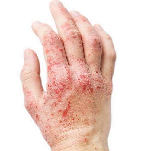 Eczema