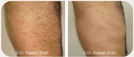 Urticaria before and after homeopathic treatment