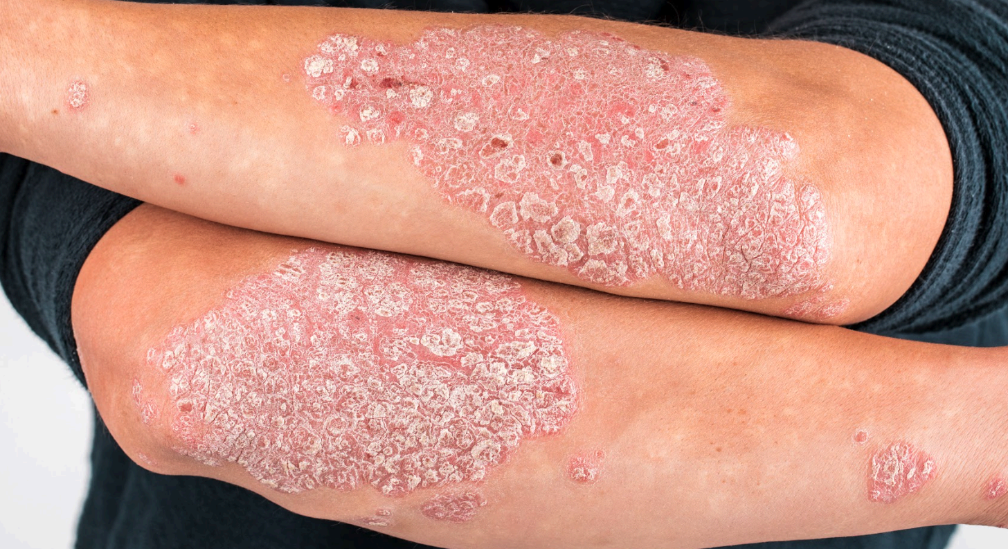 Psoriasis